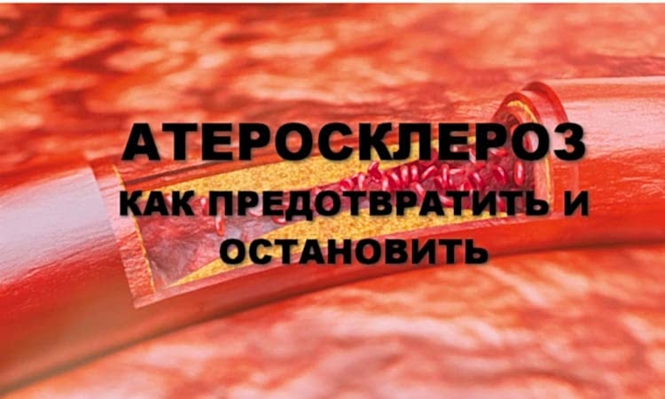 лечение астеросклероза